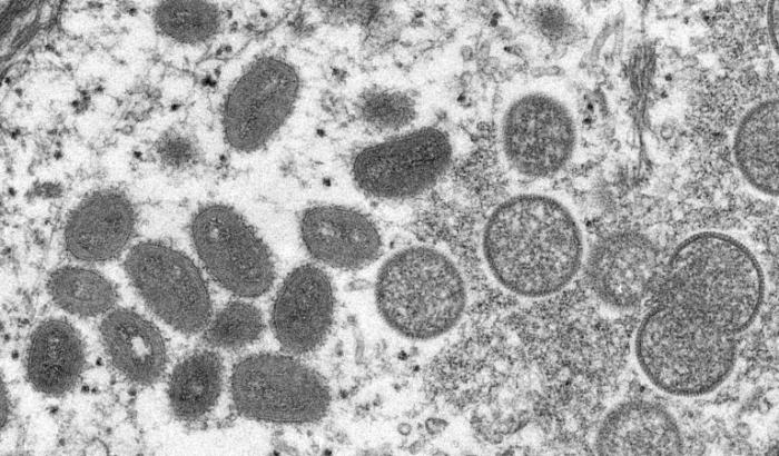 Weil sie illegal Mpox-Virenproben ins Land eingeführt haben sollen, wird in den USA gegen zwei Virologen eines renommierten Forschungsinstituts ermittelt.