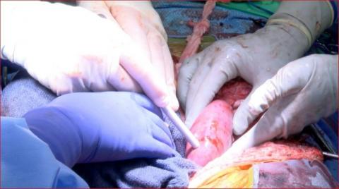 Photo fournie par l'Université d'Alabama montrant la transplantation d'un rein de porc sur un patient en état de mort cérébrale, le 30 septembre 2021