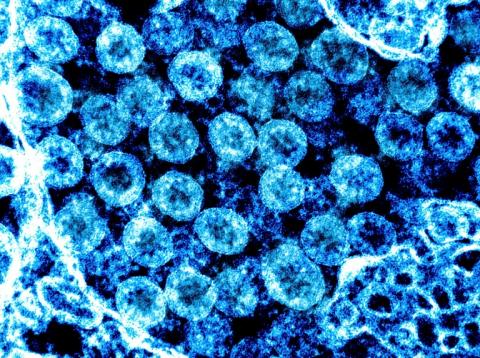 Einer neuen Studie der Berliner Charité zufolge kann der Covid-19-Erreger nur in sehr begrenztem Maß die Zellen der menschlichen Lungenbläschen direkt infizieren.