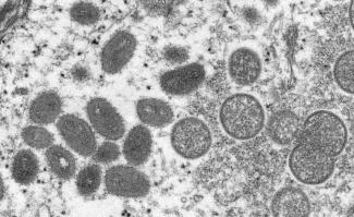 Weil sie illegal Mpox-Virenproben ins Land eingeführt haben sollen, wird in den USA gegen zwei Virologen eines renommierten Forschungsinstituts ermittelt.